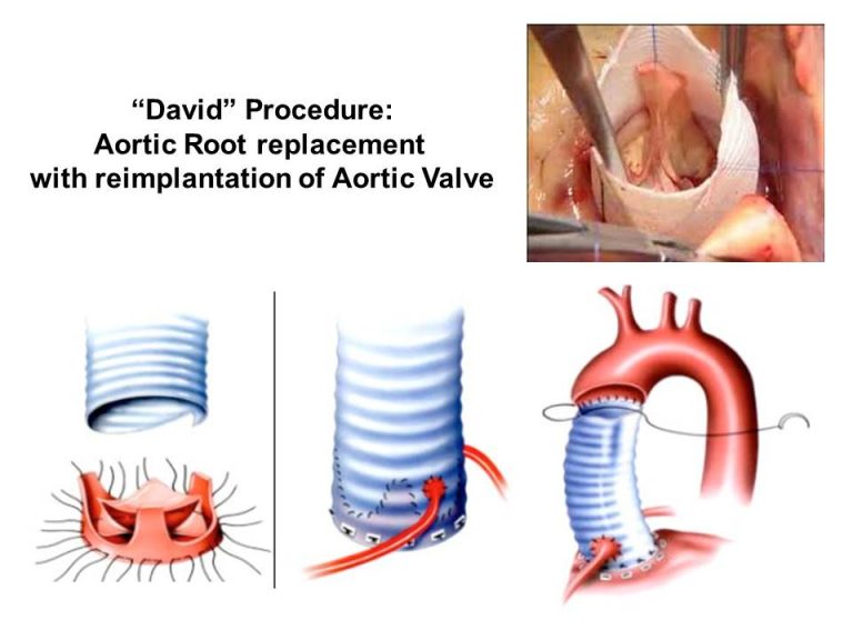 Aortic Root Replacement – Prof. Olivier Jegaden, MD, PHD.