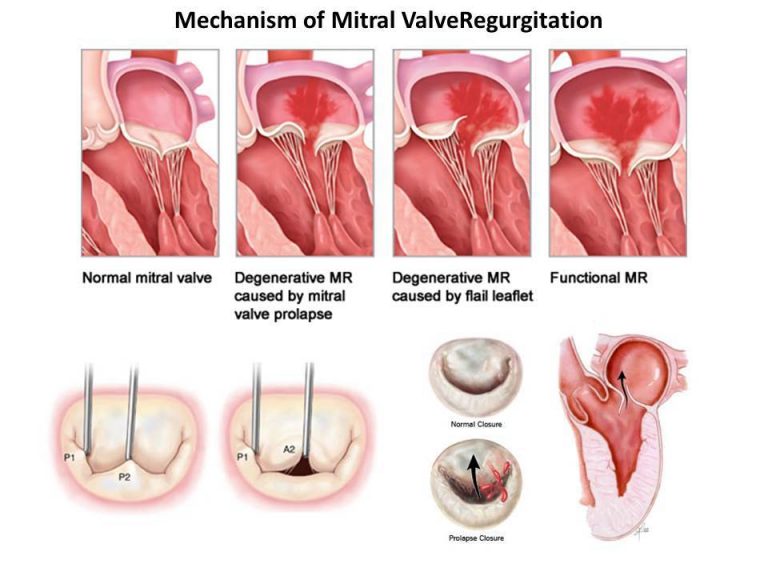 Mitral Valve Prolapse Echocardiogram