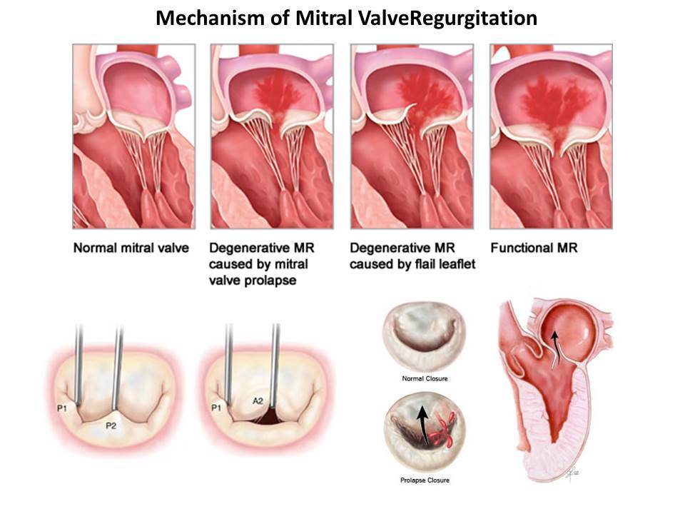 life expectancy after mitral valve regurgitation Patrica Farrell