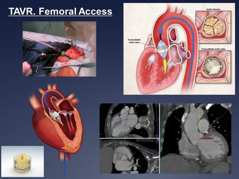 TAVI / TAVR Transcatheter procedure Prof. Olivier